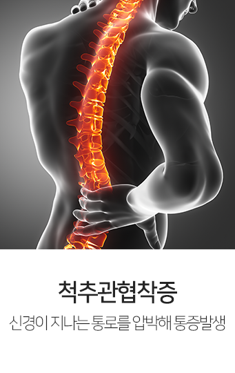 척추관협착증-신경이-지나는-통로를-압박해-통증-발생