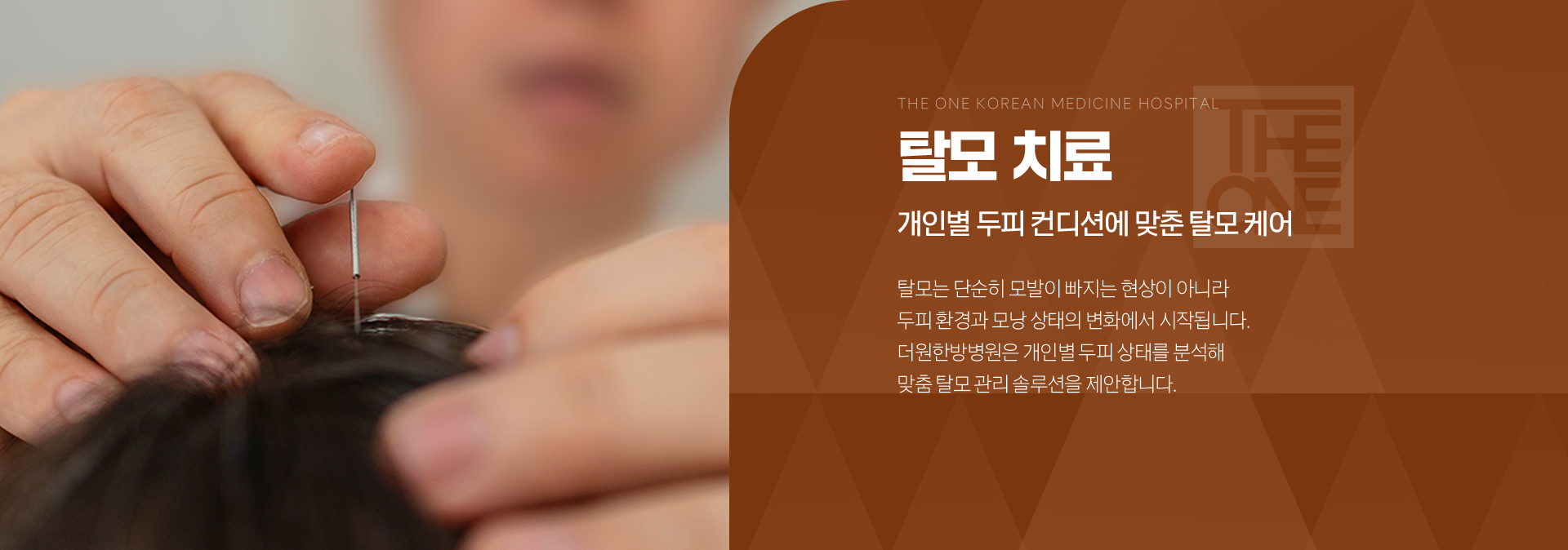 탈모 치료