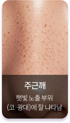 주근깨