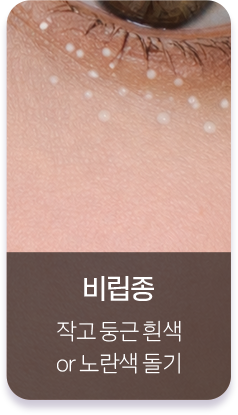 비립종