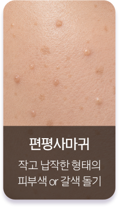 편평사마귀