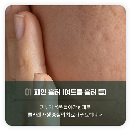 흉터치료 1