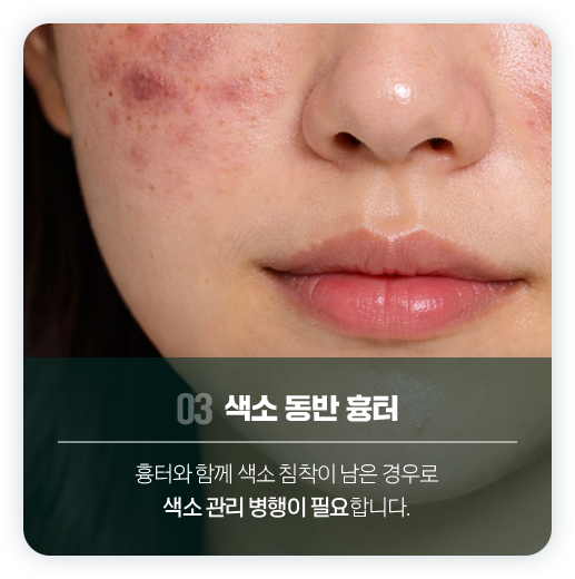 흉터치료 3